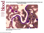 Asymptomatic filariasis