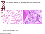 Backache and breast cancer