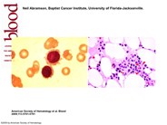 Pancytopenia and large spleen