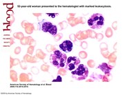 Hypereosinophilia