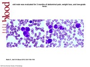 Anaplastic large cell lymphoma in bone marrow