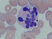 Hypersegmented Neutrophil