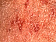 Amyloidosis: Acquired Factor X Deficiency - 1.