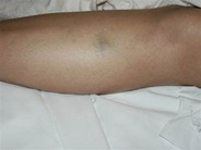 Amyloidosis: Acquired Factor X Deficiency - 2.