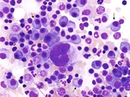 Amyloidosis: Acquired Factor X Deficiency - 4.