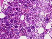 Essential Thrombocythemia: Acquired von Willebrand Syndrome - 4.