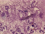 Gout - synovial fluid