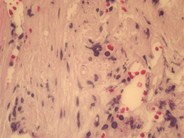 Primary myelofibrosis - fibrotic stage