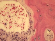 Primary myelofibrosis - fibrotic stage