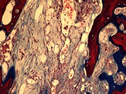 Primary myelofibrous - fibrotic stage