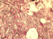 Primary myelofibrosis - fibrotic stage