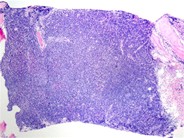 Chronic Lymphocytic Leukemia: Thrombocytopenia - 12.