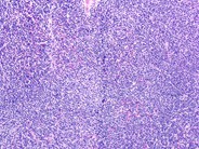 Chronic Lymphocytic Leukemia: Thrombocytopenia - 13.