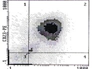 Chronic Lymphocytic Leukemia: Thrombocytopenia - 5.