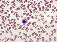 Idiopathic Thrombocytopenic Purpura - 3.