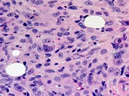 Acute Megakaryoblastic Leukemia - 3.