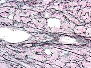 Acute Megakaryoblastic Leukemia - 5.