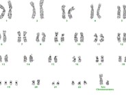 Acute Megakaryoblastic Leukemia - 7.