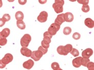 Multiple Myeloma: Platelet Dysfunction - 1.