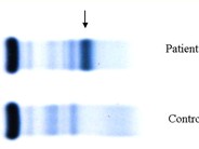 Multiple Myeloma: Platelet Dysfunction - 7.