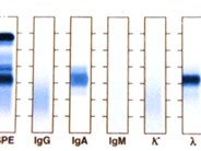 Multiple Myeloma: Platelet Dysfunction - 8.