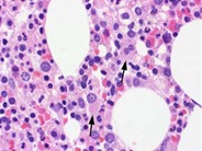 Myeloid Neoplasms. Myelodysplastic Syndrome: Refractory Ctyopenia with Multilineage Dysplasia - 4.