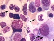 Myeloid Neoplasms. Myelodysplastic Syndrome: Refractory Ctyopenia with Multilineage Dysplasia - 9.