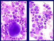 Myelodysplastic Syndrome: Refractory Anemia with Ringed Sideroblasts (RARS) - 4.