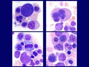 Myelodysplastic Syndrome: Refractory Anemia with Ringed Sideroblasts (RARS) - 6.