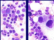 Myelodysplastic Syndrome: Myelodysplastic Syndrome Associated with Isolated del(5q)Chromosome Abnormality ('5q- Syndrome') - 6.