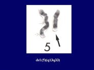 Myelodysplastic Syndrome: Myelodysplastic Syndrome Associated with Isolated del(5q)Chromosome Abnormality ('5q- Syndrome') - 7.