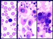 Myelodysplastic Syndrome: Myelodysplastic Syndrome Associated with Isolated del(5q)Chromosome Abnormality ('5q- Syndrome') - 8.