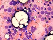 Chronic Lymphocytic Leukemia - 7.