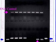 Chronic Myelogenous Leukemia - 12.