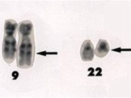 Chronic Myelogenous Leukemia - 14.