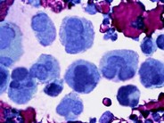 Chronic Myelogenous Leukemia - 8.