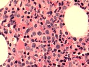 Chronic Myelomonocytic Leukemia - 6.