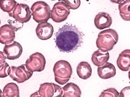 Hairy Cell Leukemia - 2.