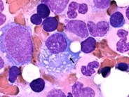 Multiple Myeloma - 4.