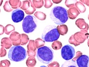 T-cell Prolymphocytic Leukemia - 1.