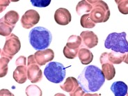 T-cell Prolymphocytic Leukemia - 2.