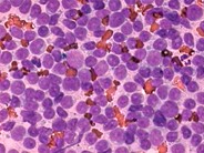 T-cell Prolymphocytic Leukemia - 4.