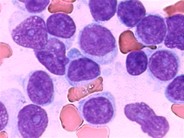 T Cell Prolymphocytic Leukemia 5