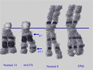 T-cell Prolymphocytic Leukemia - 8.