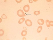 Pernicious Anemia - 1B