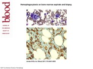 Hemophagocytosis on bone marrow aspirate and biopsy