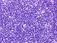 Follicular Lymphoma, Grade 1/3 - 4.