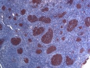 Follicular Lymphoma, Grade 1/3 - 7.