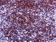 Follicular Lymphoma, Grade 1/3 - 8.