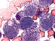 Mast Cell Leukemia - 1.